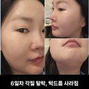 쏠라 | 청담 쏠라pdt 쏠라테라피 무보정 후기