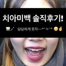 이수역치과에서 치아미백 받고온 솔직 후기!! / 이수치아미백치과 / 비포애프터 / 치아미백 가격