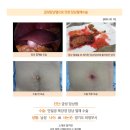 급성담낭염수술후기. 주변에 담낭 수술 한다고 하면 소개해줘도 고맙다고 칭찬 받을 것 같아요. 건강하게 퇴원하게 되서 기쁩니다. 이미지