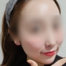 에그멍 | 압구정피부과 코레지 에그리프팅으로 모공 탄력 개선했던 후기