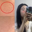 이건한의원 | 여드름 패인흉터 제거 치료 노원 피부과 한의원 새살침 솔직후기