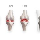 무릎 구부리거나 계단 오르내릴때 통증 원인과 염증 증상 이미지