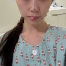 하당약국 | 코젤코 수술 후기 (1) 당일-2주차