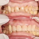 사릉역 | 사릉역치과, 대표원장이 직접 설명하는 앞니 치료 기준