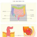 항문 괄약근 기능장해로 인공항문을 설치한 경우 &#34;약간의 장해&#34;를 받을 수 있습니까? 이미지