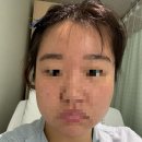 성호고등학교 | 급성담낭제거수술과 ercp시술 그리고 제거 후기..