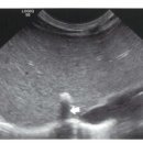 Liver calcification 이미지