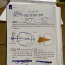 &#34;아이리움안과&#34; 렌즈삽입 2년 후기