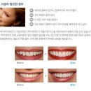아이디치과기공소 네이버블로그