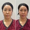 용한의원 | 부산안면비대칭교정 한의원 교정관리프로그램 6회차 후기 | 중안면부축소, 비대칭을 교정 관리받고 왔어요.