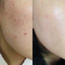 좁쌀여드름 압출 5회차 세종 미온에스테틱 후기