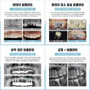 동탄 임플란트 보철과 전문의를 찾는 이유 이미지
