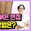 피부 붉은 반점의 원인 치료방법 이미지