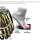 foot drop, 족근관 증후군(tarsal tunnel syndrome)과 지간신경종(morton's neuroma) 이미지