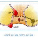 항문질환 치열 증상 치루 증상 수술 치료 예방 항문 농양종기 이미지