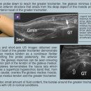 근골격계sono자료 gluteus minimus, gluteus medius and fascia lata 이미지