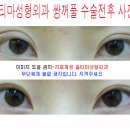 쌍꺼풀 수술전후사진 첨부-쌍커풀,쌍커플,쌍꺼플수술,눈성형,눈매교정술수술비용 이미지