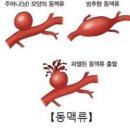 대동맥류(혹) 원인 증상과 자가 진단 방법 손가락으로 알 수 있을까? 이미지