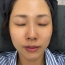 준메디칼스킨케어 | 기미와 잡티 고민일 때 이음메디컬스킨 쌍문본점 파워기미잡티케어 후기