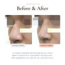 뉴스타일성형외과의원 네이버블로그