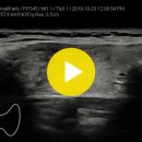 thyroid sono-papillary CA(유두암) 이미지