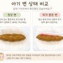 가야-10 | 10개월 아기 혈변, 응급실 가야 하나? 소아과 다녀온 후기