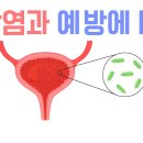 방광염(오줌소태) 이렇게 방지 하세요 이미지