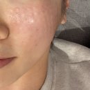 굿모닝피부과의원 | 연차 알차게 쓰기 1탄 : 망포 브런치 먹고 리쥬란 맞기