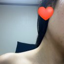삼잘한의원 | 편평사마귀 제거 일대기_편평사마귀 300개이상 제거 후 한달 후기