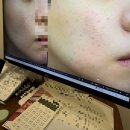 선명한의원 | 부산여드름흉터한의원에서 새살침 5회차 받은 후기 <내돈내산>