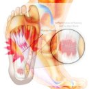 참좋은보조기 | 대전 족저근막염 병원 정형외과 다녀온 후기 (feat. 족저근막염 보조기 추천)