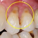 치경부 마모증 [Cervical abrasion] 이미지