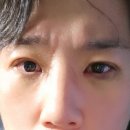 아크성형외과의원 | 눈 성형 후기(수술 후 8일차)