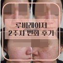 루나의원 루비레이저 후기 7일차부터 2주차까지 솔직하게 기록한 주근깨 잡티제거 변화