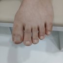 365늘봄메디칼의원에서 훌륭한 발톱무좀 치료과정 &amp; 후기ㅎㅎ
