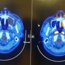 치료 후 3개월 PET CT 검사 결과 이미지