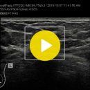 breast mass(Categoly 4a)-internal vascularity 이미지