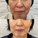 라미르스킨룸 | 라미르스킨룸 임상 모음집.jpg