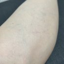 명동역피부과 젠틀맥스프로플러스후기 종아리제모 2회차