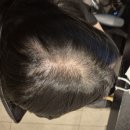 비알 | 여성탈모 고민러의 비알머드 탈모샴푸 솔직후기