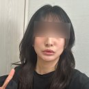 연세박세진의원 | 연세보드미의원 편평사마귀 제거 당일과 두 달 후 후기 관리법 포함