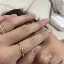 부산 아기 흉터치료 봉합 흉터 뉴 울트라펄스 앙코르 3회차 진료후기
