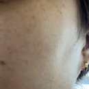 지우약국 | 대구 기미 잡티 제거 치료 잘하는곳 추천 피부과상담 비교 가격 내돈내산후기