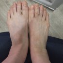 [6개월간의 발톱무좀 치료 후기] 먹는 약 + 연고 + 쥬블리아까지! 확실히 효과 본 리얼후기