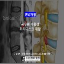 못골로01 | -후기- 공무원 수험생 허리디스크 극복! 4주 만에 통증 없이 공부하는 법