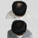 인천두피관리 전후 차이 확실히 느낄 수 있는 토니에스엠피스튜디오