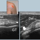 회전근개파열 - 극상근 (Rotator Cuff Tear - Supraspinatus) 이미지