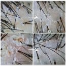 메디플러스 의원 | 원주두피관리 스칼프메디에서 두피정밀검사 스케일링 받은 후기