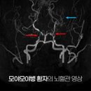 뇌혈관질환 종류 증상 모야모야병 원인 치료 이미지