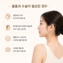심진희헤어 | 돌출귀 수술, 정면에서 보이는 귀가 고민이라면?
